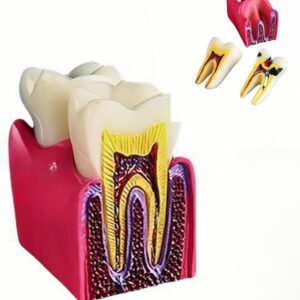 6pcs Dental Caries Teaching Model